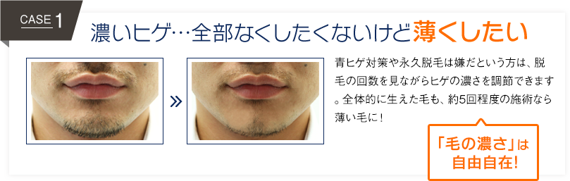 青髭を消す方法