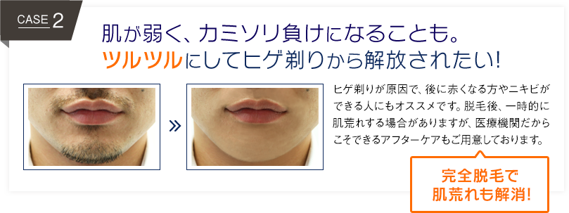 髭が濃くなる年齢