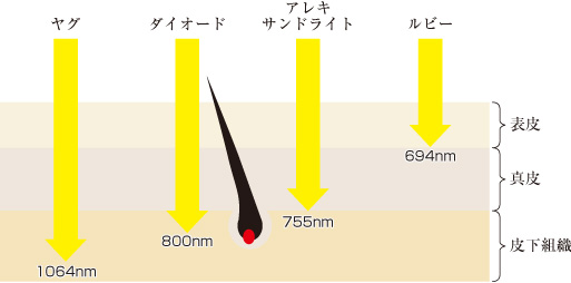 医療レーザー髭脱毛に適してる種類のレーザー比較