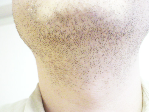 メディオスターNextPro1回目