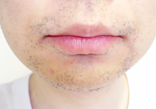 メディオスター髭脱毛3回目3日後