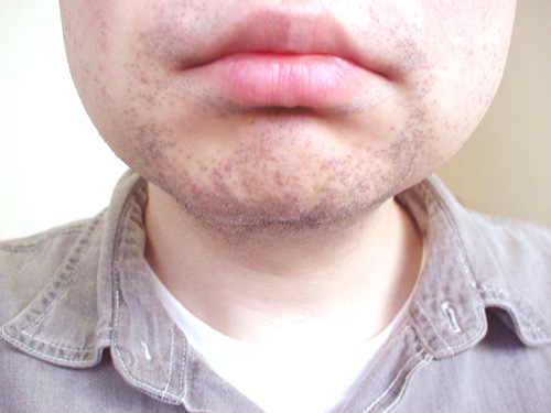 メディオスター髭脱毛5回目