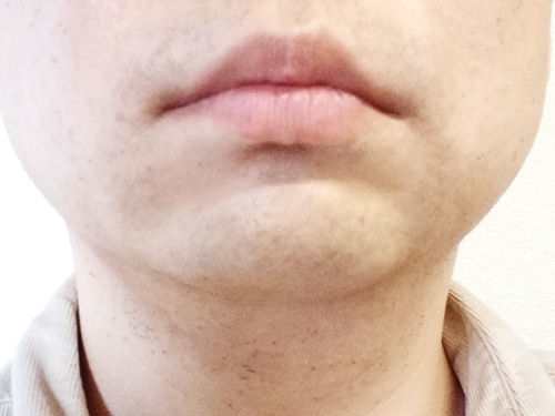 メディオスターNextPro髭脱毛6回目