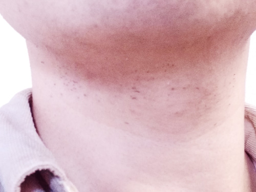 メディオスターNextPro髭脱毛6回目首周り