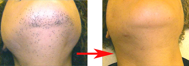 メディオスター髭脱毛効果なし