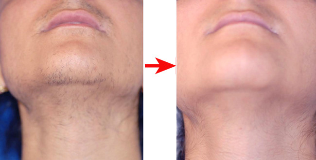 メディオスター髭脱毛効果なし