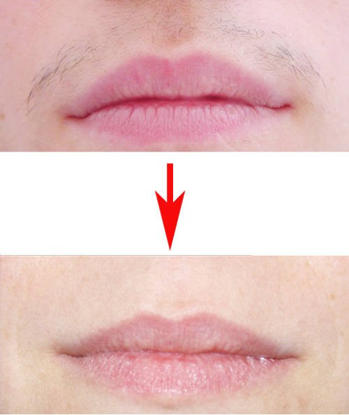 メディオスターNextPro効果なし