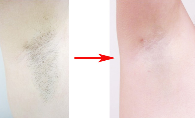 メディオスター脱毛ワキ効果なし