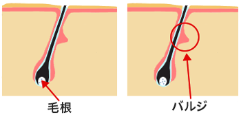 メディオスターが破壊出来る「バルジ領域」の図解
